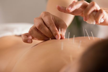 What Is Acupuncture